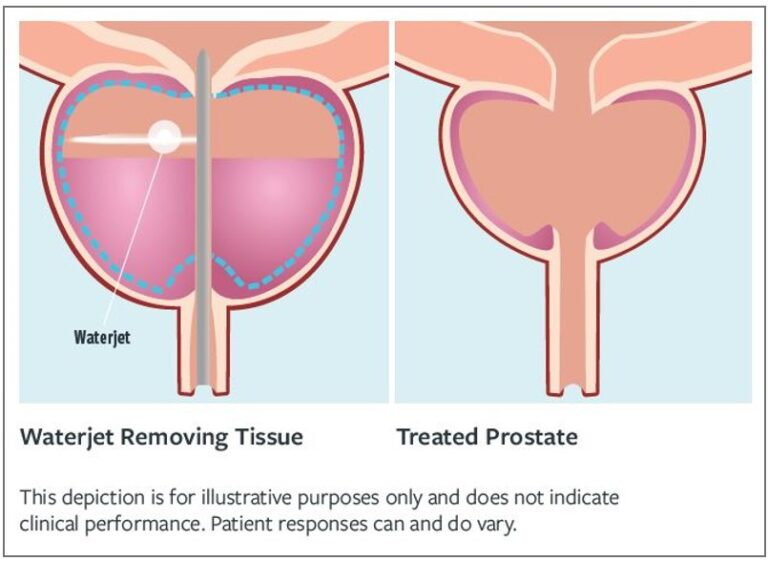 Prostate Button Aquablation Therapy | Treatments | Birmingham Prostate Clinic